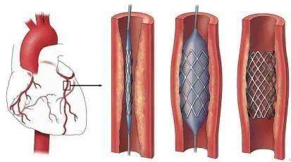 心臟支架上市,??心臟支架全新上市?,守護你的心臟健康??