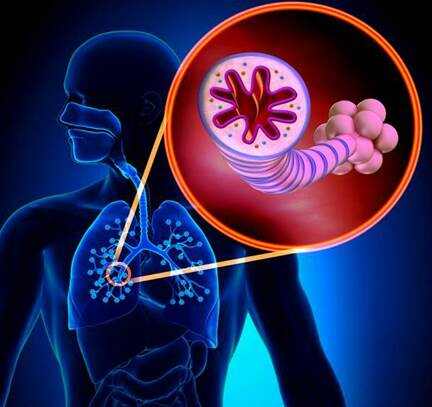 支氣管擴張新治療技術,重塑呼吸健康,開啟新生活篇章