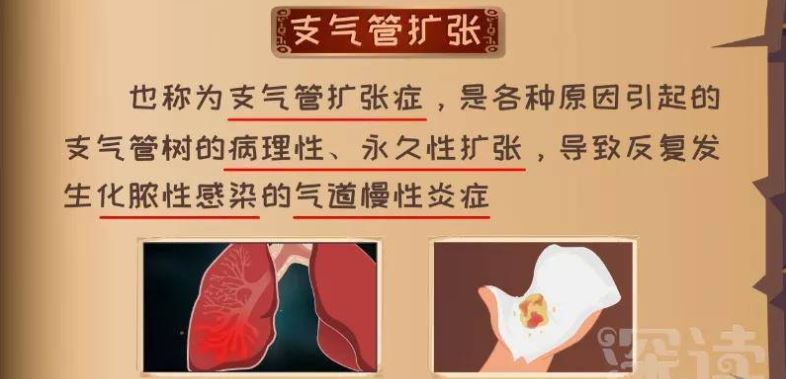 支氣管擴張新治療技術,重塑呼吸健康,開啟新生活篇章