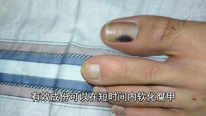 揭秘醫院治療灰指甲價格與小巷深處的特色小店探秘