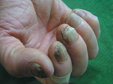 揭秘醫院治療灰指甲價格與小巷深處的特色小店探秘