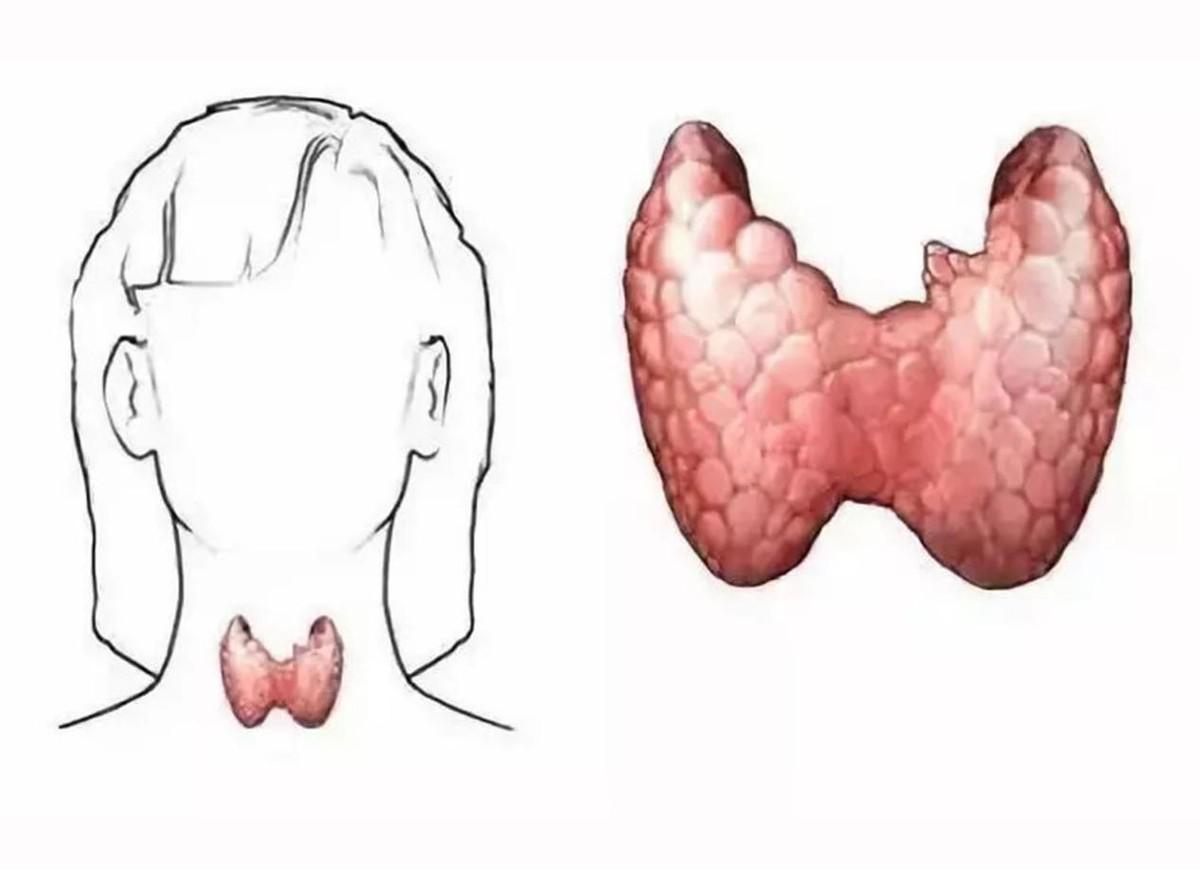 最新甲狀腺檢查步驟指南，詳細步驟解析