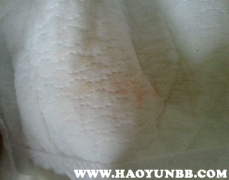 最新肺炎淤青的成因、表現(xiàn)與防治策略解析