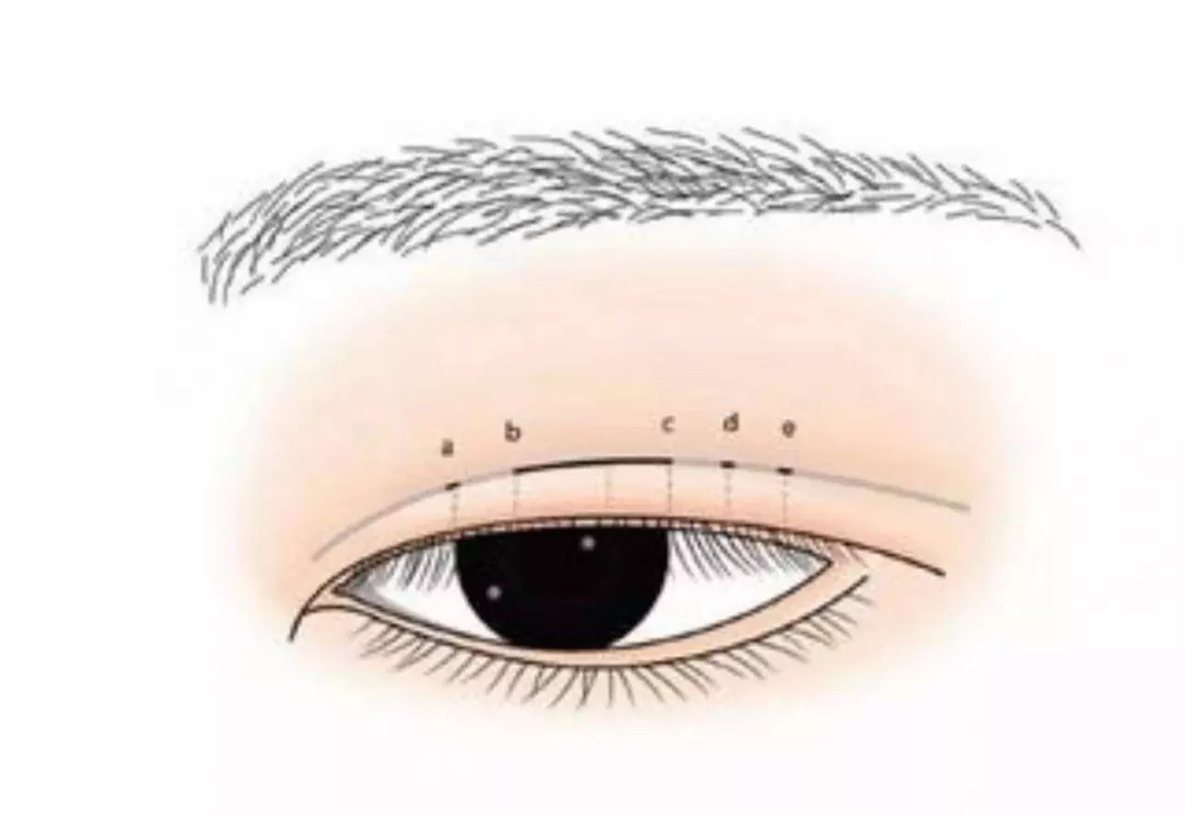 最新雙眼皮手術(shù)技巧,創(chuàng)新割雙眼皮方法解析
